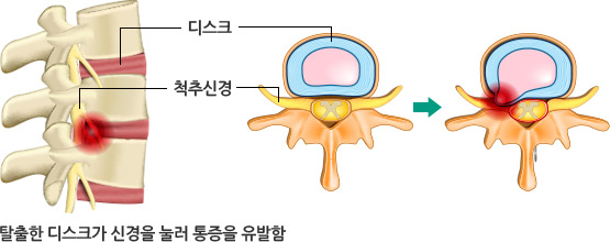 추나요법-디스크/척추신경